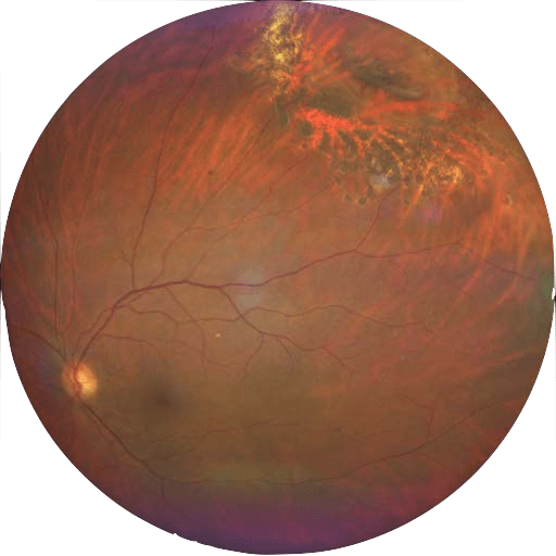 image of a retina